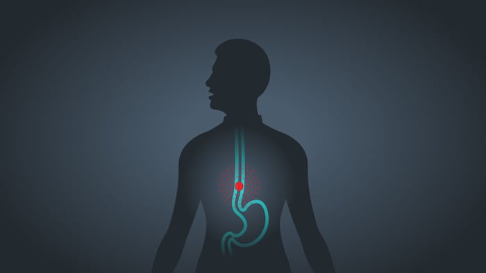 Esophageal Cancer vector