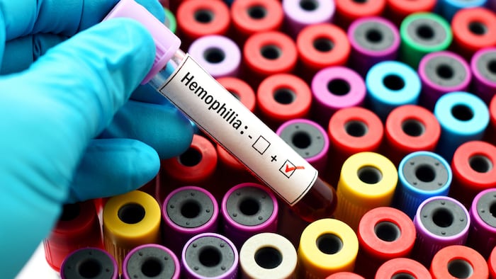 Hemophilia_525478450_1200.jpg