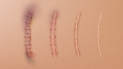 Promore’s Enserpetide Has Phase II Setback In Scar Prevention, Focus Shifts To Ropocamptide