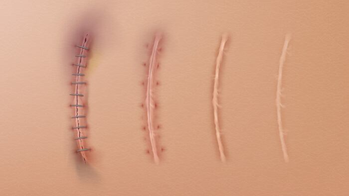 Surgical scars with stitches healing