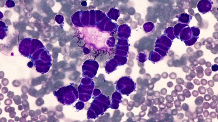 Carcinoma