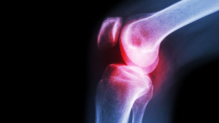 Film x-ray knee joint with arthritis