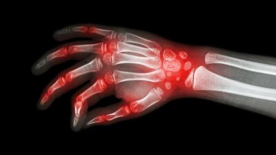 Labcorp Buys Myriad Genetics’ Vectra Autoimmune Test Business