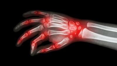 Labcorp Buys Myriad Genetics’ Vectra Autoimmune Test Business
