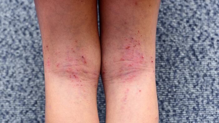 Dermatitis