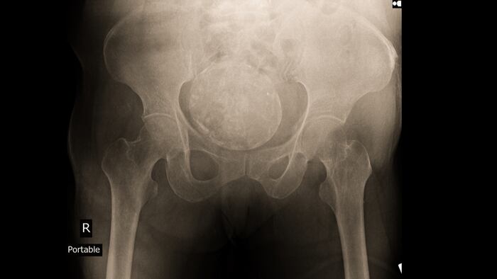 Ovarian cancer_498028882 _1200.jpg