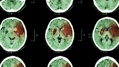 Medtronic Launches Platform To Gather Ideas To Improve Stroke Treatment