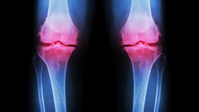Merck KGaA Finds The Right Home For Disease-Modifying OA Agent In Novartis