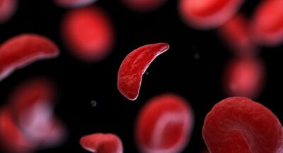 Pfizer Finally Wins English Funding For Sickle Cell Drug Oxbryta After Bumpy Ride