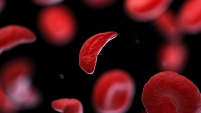 Pfizer Finally Wins English Funding For Sickle Cell Drug Oxbryta After Bumpy Ride