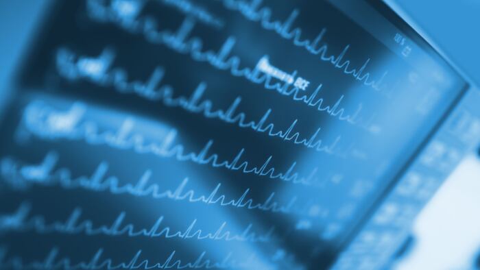 Heart activity on monitor in intensive care unit