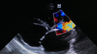 TRiCares Initiates EU Pivotal Study For Topaz Tricuspid Valve Replacement