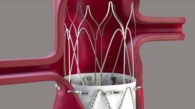 Endoron Staples Down $10M To ‘Revolutionize’ Abdominal Aortic Aneurysm Repair