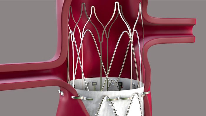 Endoron Medical Aortoseal