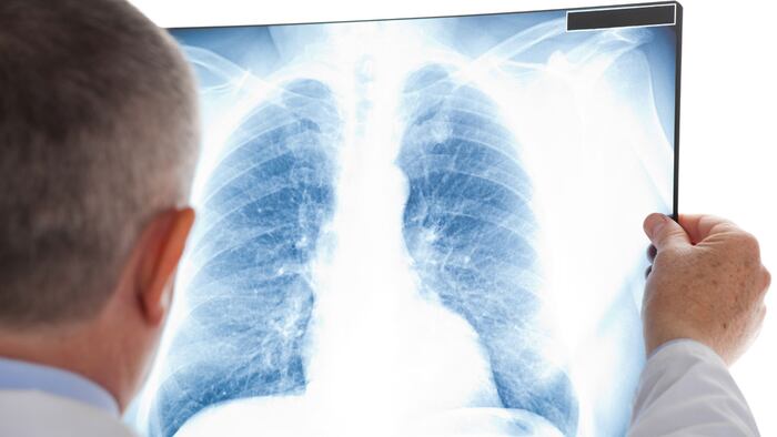 Lung radiography