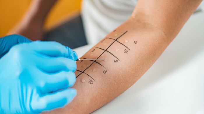 Allergy testing