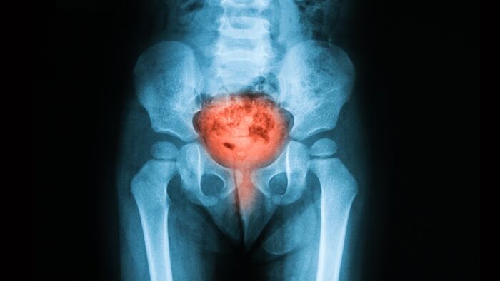 X-ray image of bladder, Showing cystitis or lower urinary tract infection