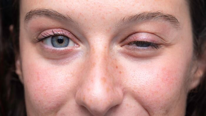 Myasthenia gravis