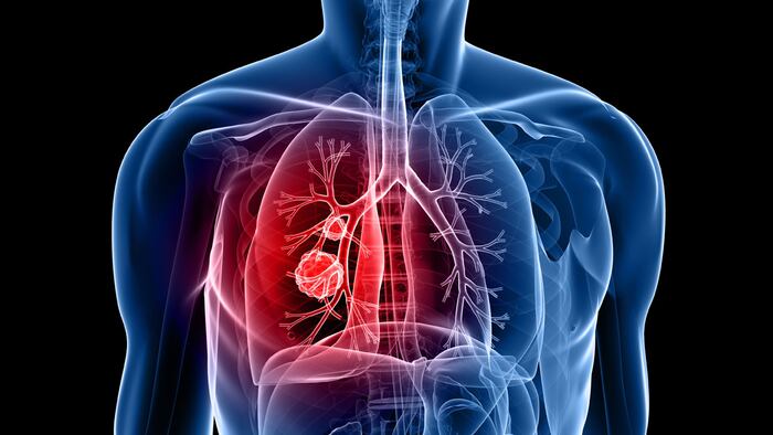 Lung cancer