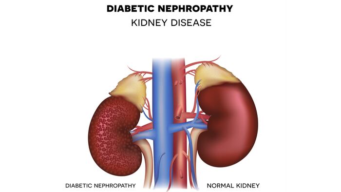 Kidney_Disease