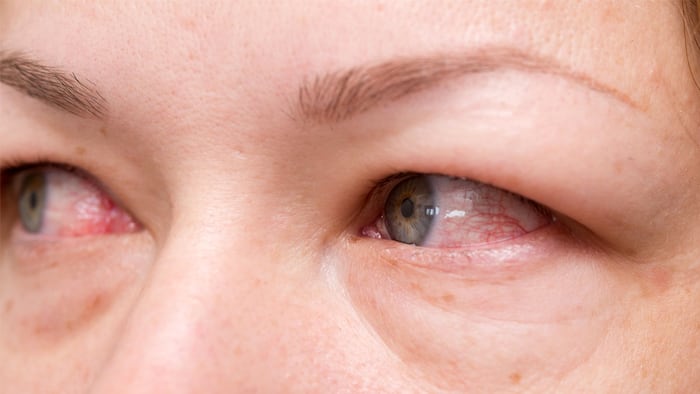 Blood shot eyes