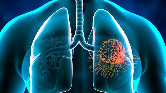 lung cancer
