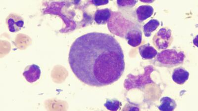NovoCure’s Tumor Treating Fields Help Mesothelioma Patients Live Longer In STELLAR Trial