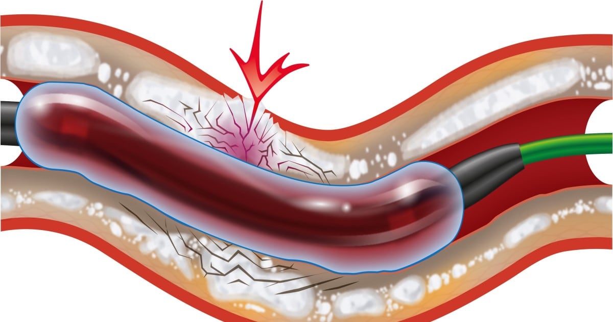 Hbw Insight FDA Approves Shockwave Coronary Intravascular Lithotripsy System