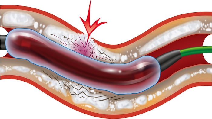 Shockwave Medical’s IVL System