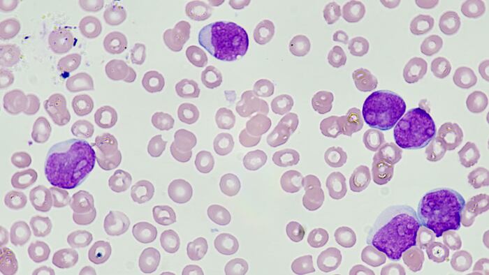 Leukemia cell (blast cell)