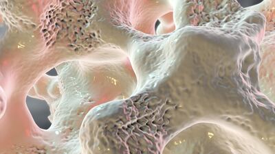 Mereo Licenses Setrusumab To Ultragenyx For Osteogenesis Imperfecta