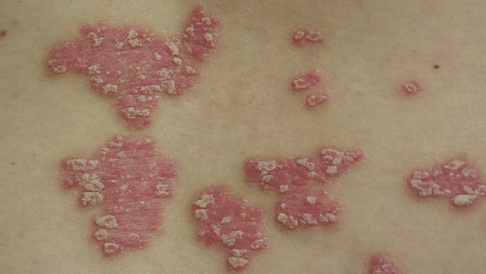 Psoriatic Skin_1200x675