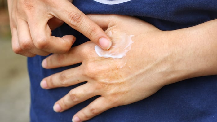 Asian woman's hand is applying medical cream at burning scar on her back hand cause by hot hot iron accidental.Permanent wound.Concepts of healthcare and beauty. K By Kotcha K Related keywords