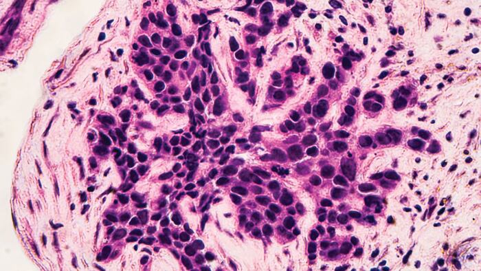 Breast Cancer Awareness: Microscopic image (photomicrograph) of core biopsy for infiltrating (invasive) ductal carcinoma, detected by screening mammogram. H & E stain.