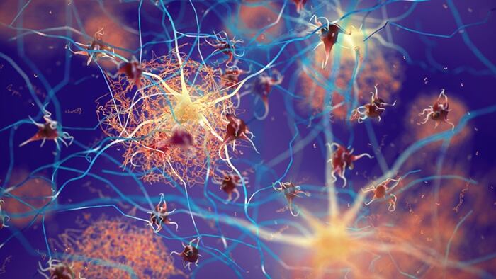 Amyloid plaques forming between neurons