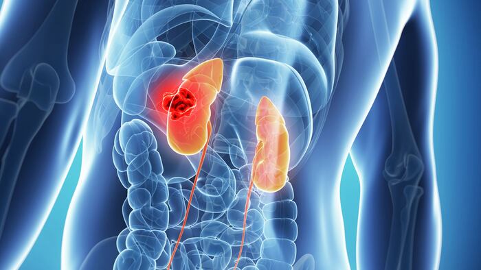Malekidneys-cancer