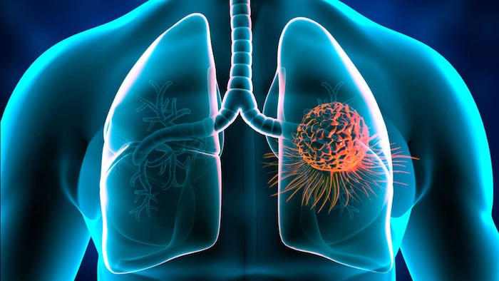 lung cancer