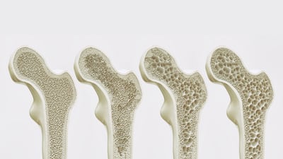 MI-MarketIntelligence (Premium-2): How to Stop Bone Loss After Denosumab? No Easy Answers