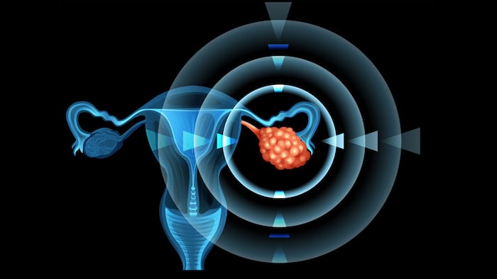 OvarianCancer_1200x675