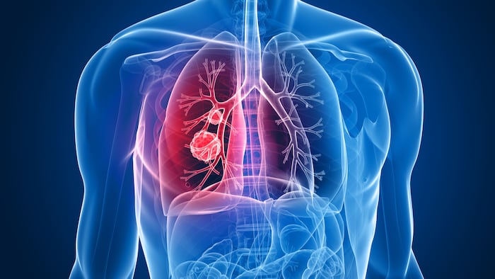 SC1910_Lung Cancer_47781766_1200.jpg