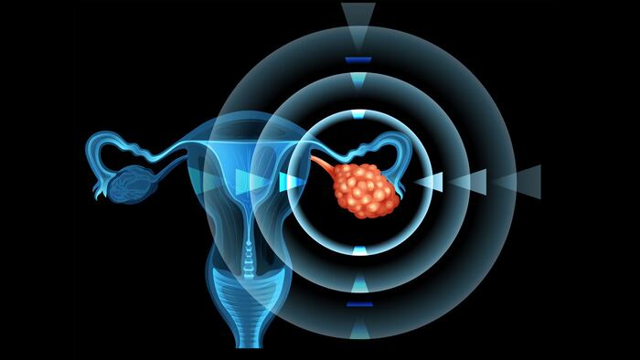 OvarianCancer_1200x675