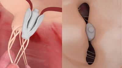 Edwards’ Pascal Improves Mitral Regurgitation In Early Trial Results