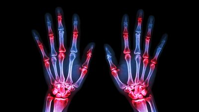 SetPoint Launches IDE Trial Of Vagus Nerve Stimulation To Treat Arthritis