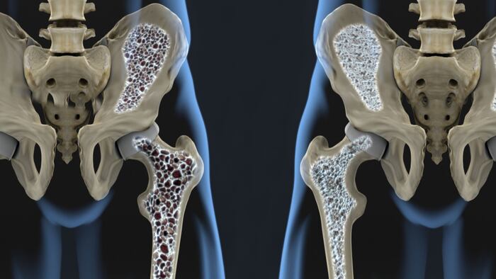 Osteoporosis