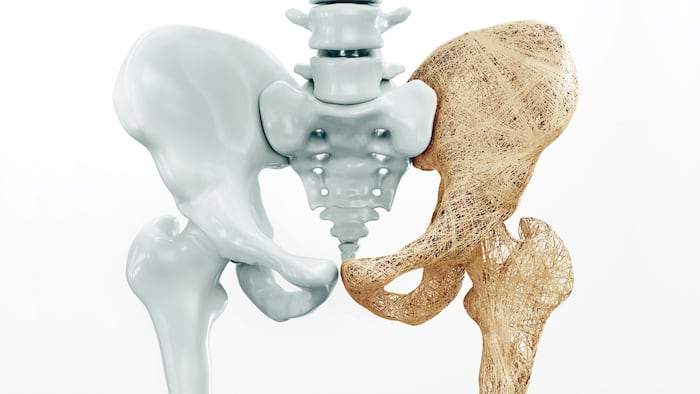 Osteoporosis upper limb bones - 3d rendering