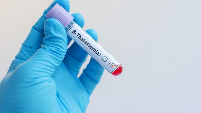 Beta thalassemia blood sample - Image