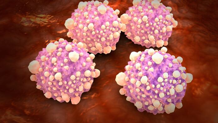 pancreatic cancer