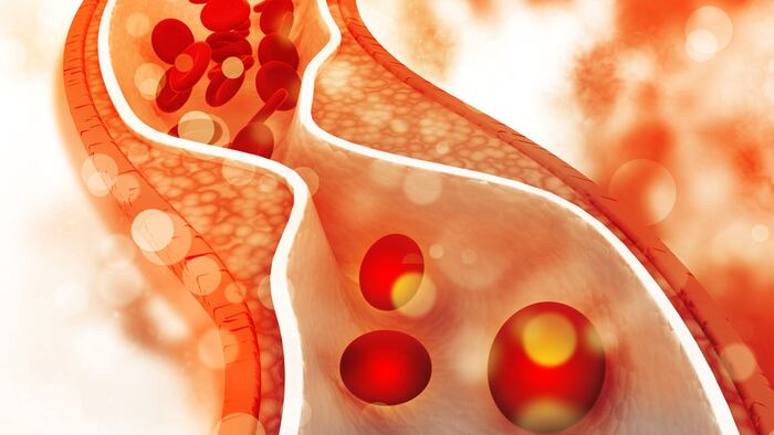 Cholesterol plaque in artery
