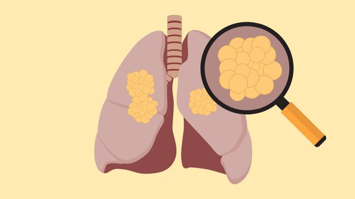lung cancer with cancer cell on the lung and magnifying glass