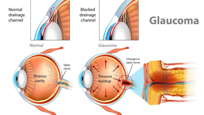 Glaucoma model